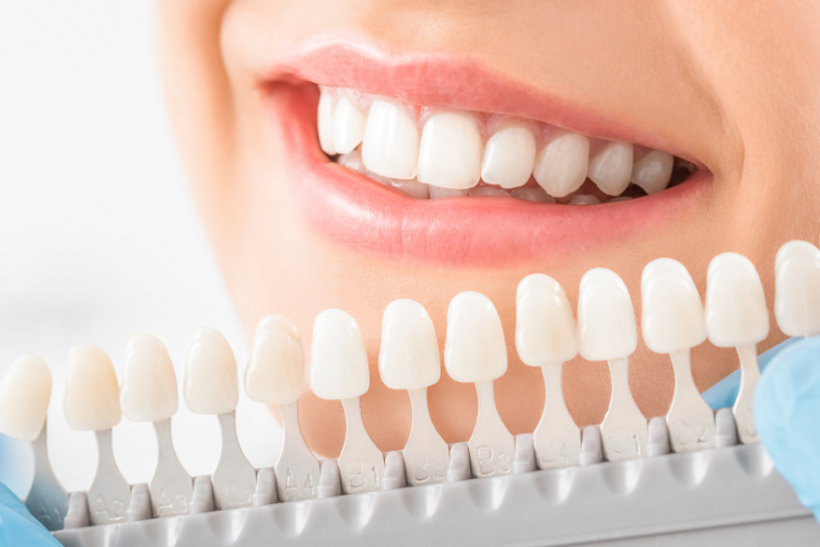 Dental Filling - Dentisry
