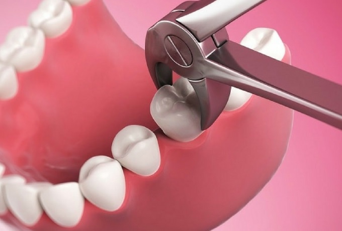 wisdom tooth removal - dentisry<br />

