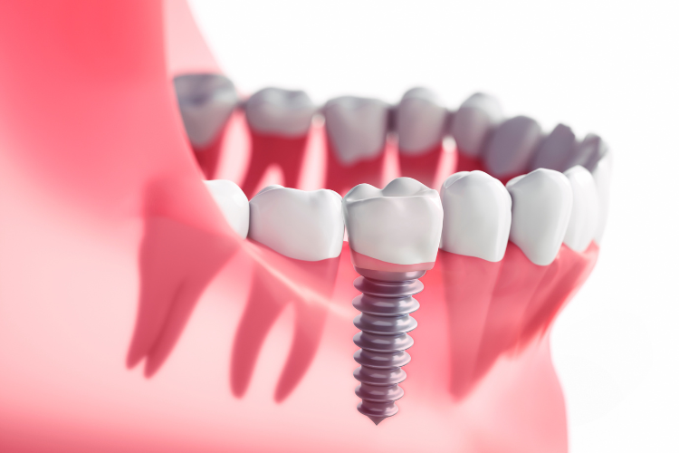 dental implantation 