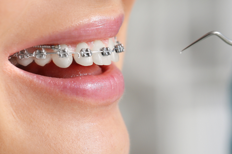 braces orthodontics dentisry