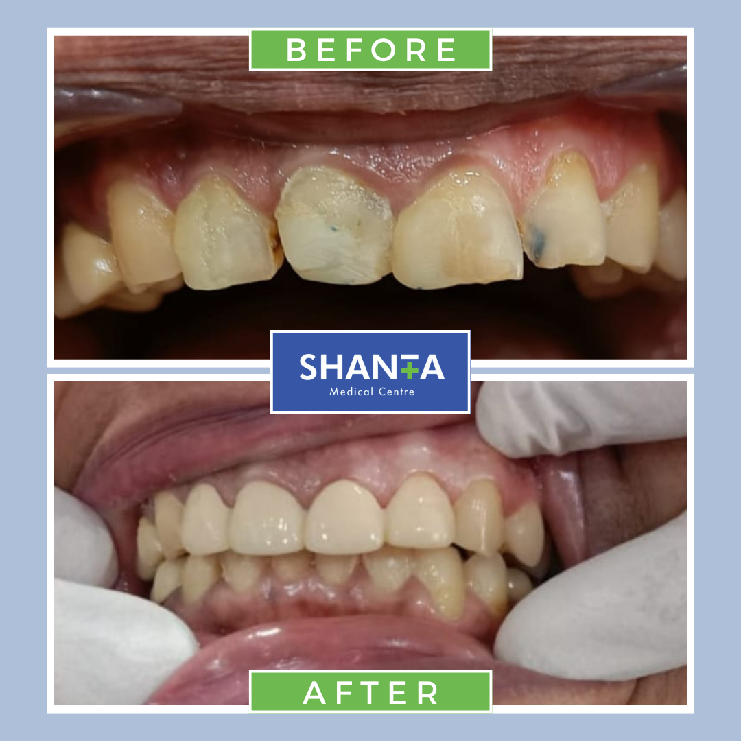 Dentistry - before - after results - shanta medical centre