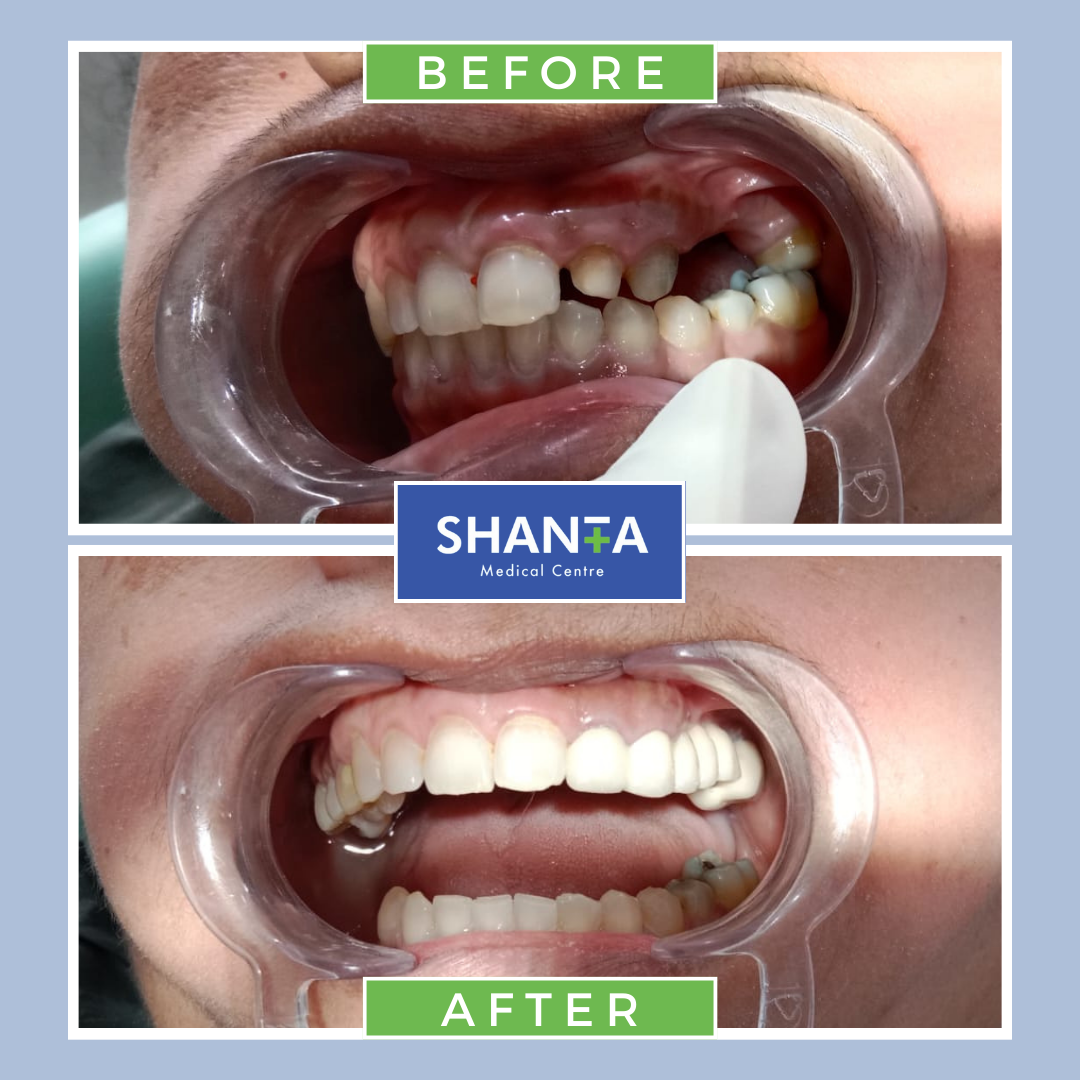 Before After teeth<br />
