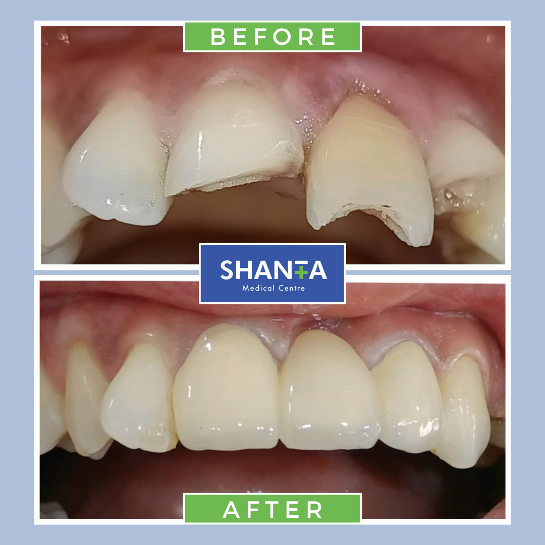 Before-after teeth treatment - shanta medical