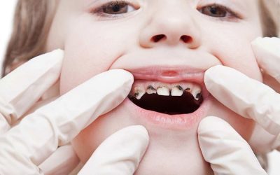 Tooth Decay: Prevention And Treatment