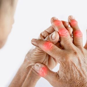 Arthritis Profile Test Package
