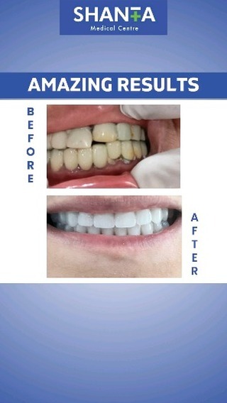 Smile Makeover Before and After Results
